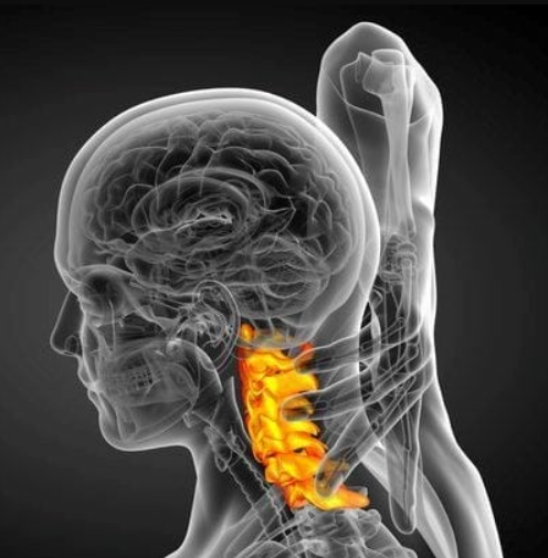 Cervical Disc Prolapse