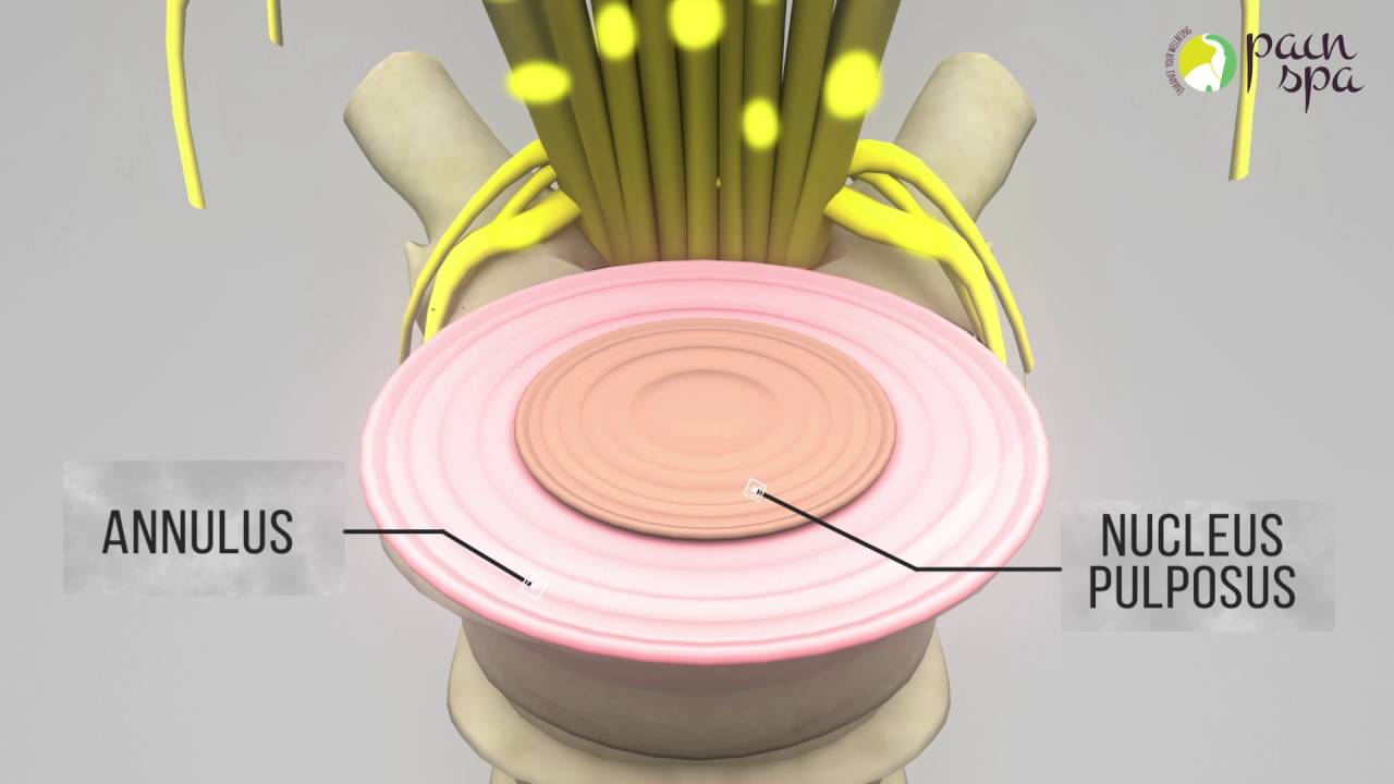 Spinal Stenosis