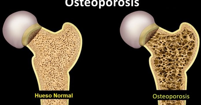 Osteoporosis