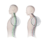 Pinched Nerve