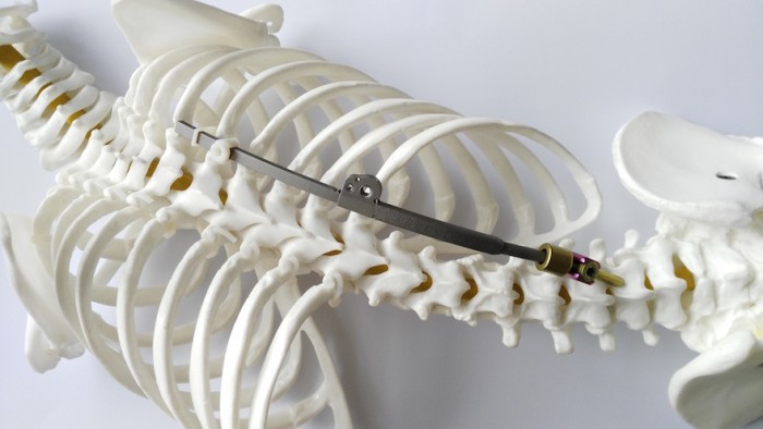 Surgery for correction of spinal deformities