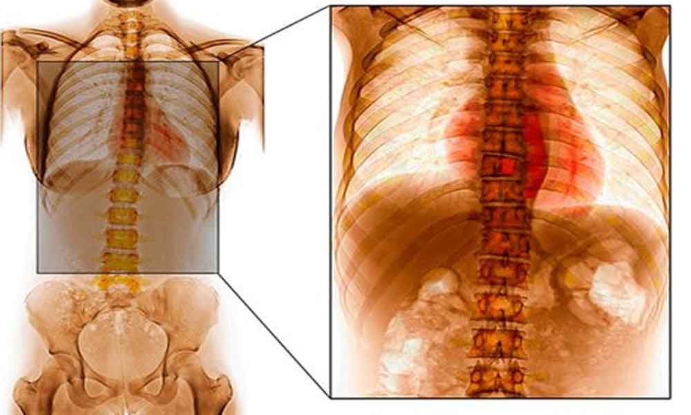 Spinal Tuberculosis