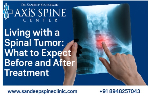 Living with a Spinal Tumor: What to Expect Before and After Treatment