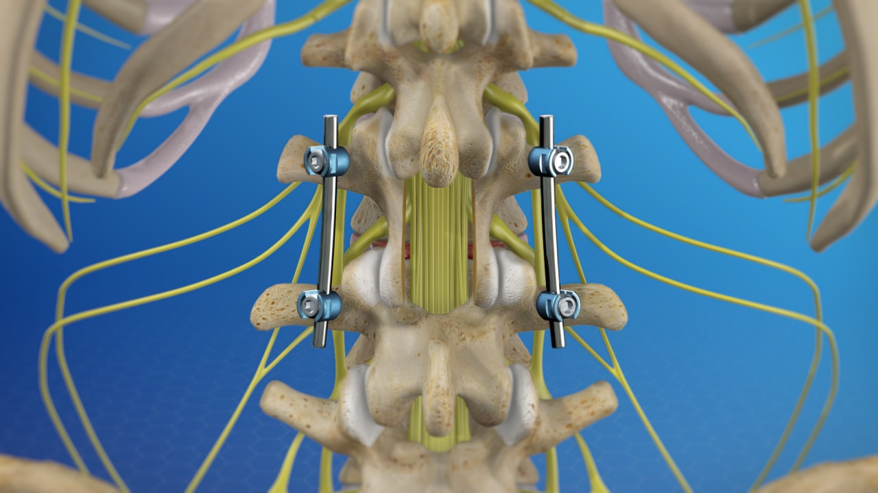 What is Lumbar Decompression and Fusion Surgery?